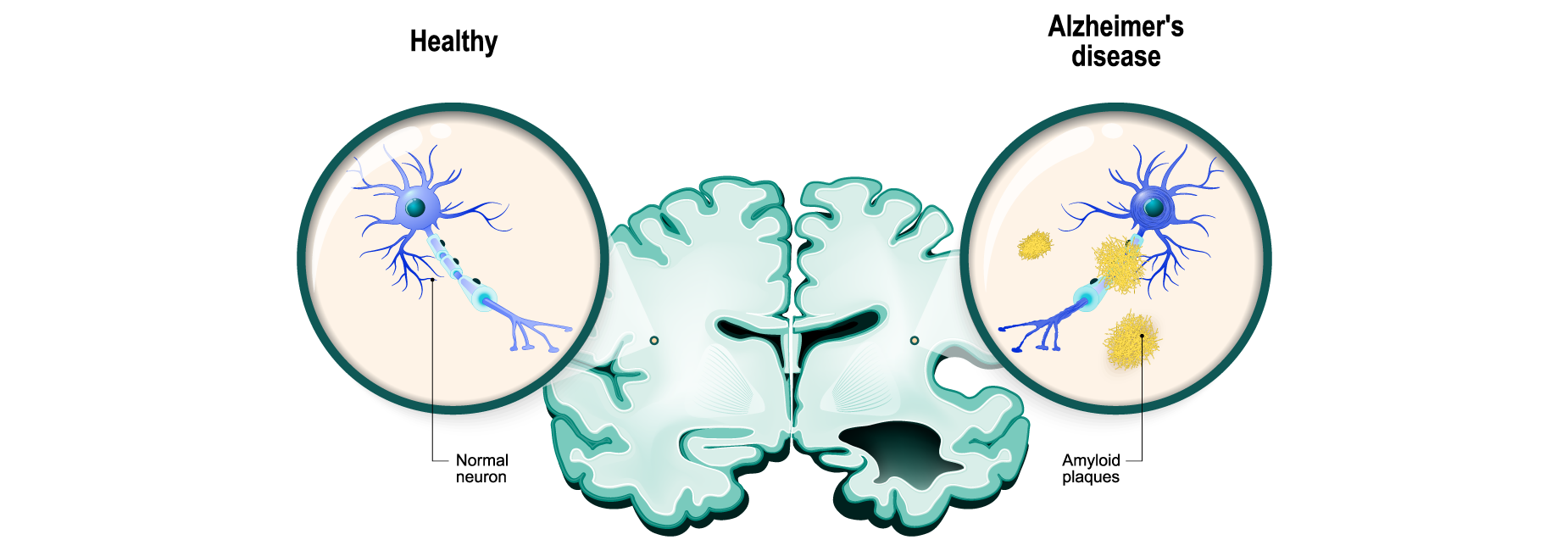 Normal ageing versus dementia - Dementia Care